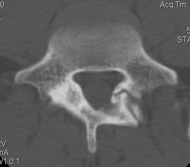 Axial Spine CT